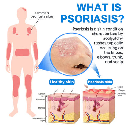 Official Store✅: 𝐂𝐯𝑟𝑒𝑜𝑧® Magnesium Herbal Psoriasis Spray ⚕ MHRA Certified